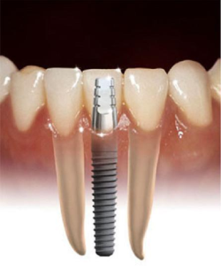 Implantes dentários, Aparelhos Ortodonticos/ DR. Ramon Mesquita